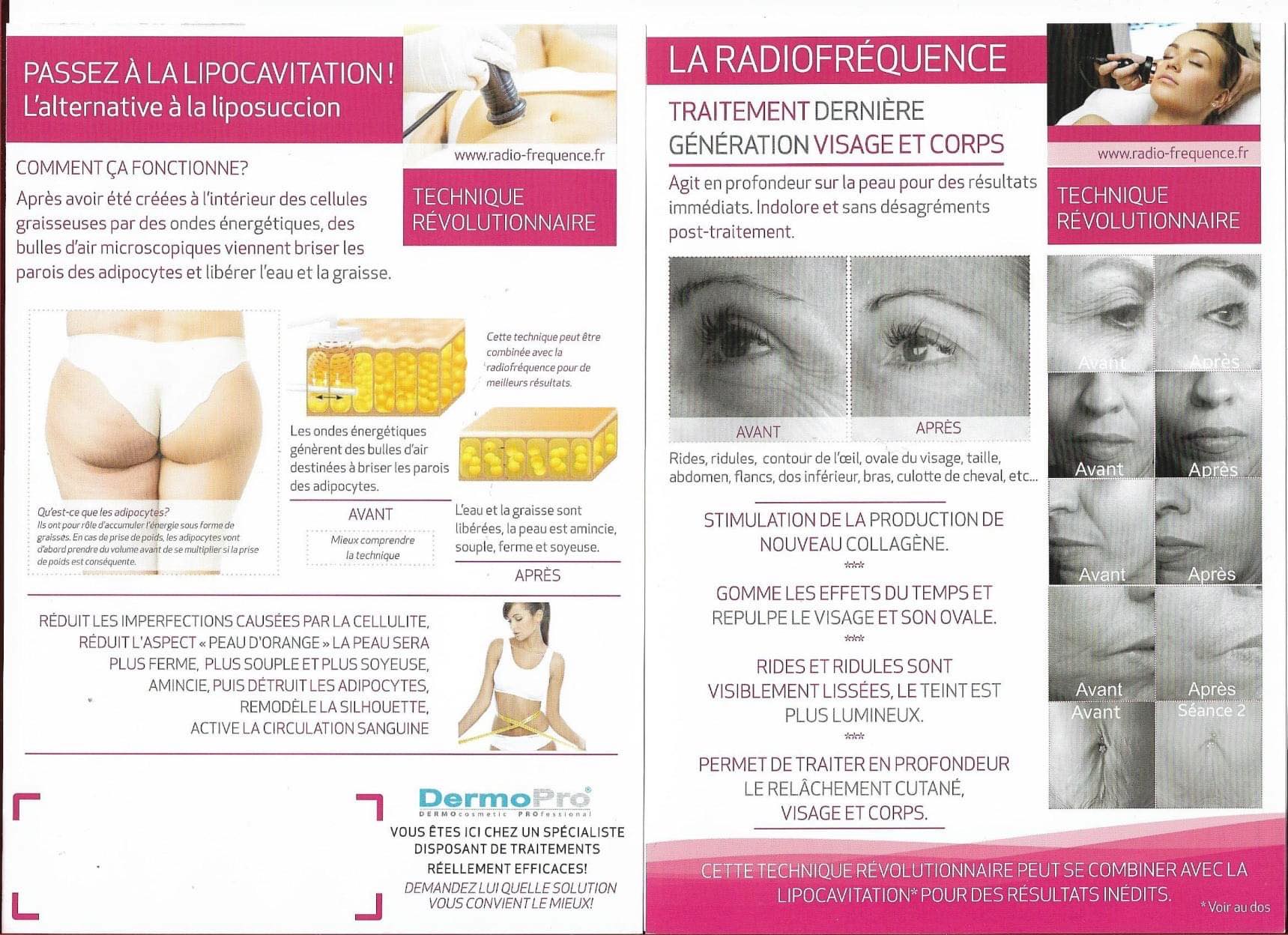 Lipocavition & radiofréquence